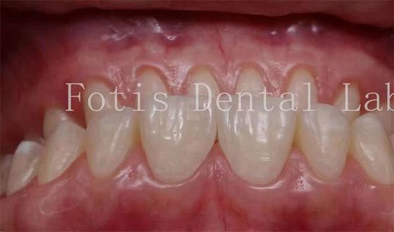 Προσαρμοσμένη φυσική εμφάνιση Snap On Veneers 0.3mm-0.5mm πάχος