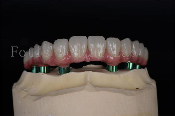 Μακροχρόνια Titanium/Zirconia All on 4/6 Implants Εύκολη συντήρηση Υψηλό ποσοστό επιτυχίας
