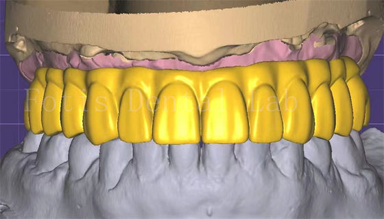 Επαγγελματικό σχεδιασμό 3shape Crown Εξαιρετική απόδοση και αντοχή