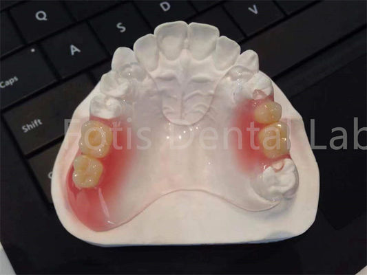 Ευέλικτο TCS Valplast Οδοντιατρικές συσκευές άνετο ανθεκτικό σχεδιασμό